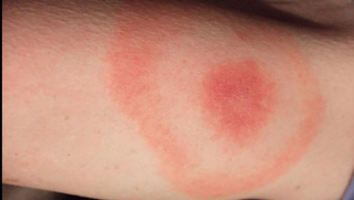 Illustration for article titled Did You Know Getting Bit By A Tick Could Paralyze Your Face?